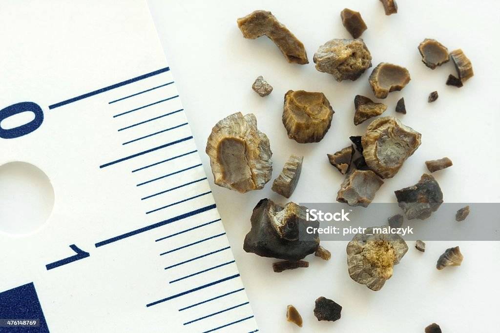 Cálculo renal